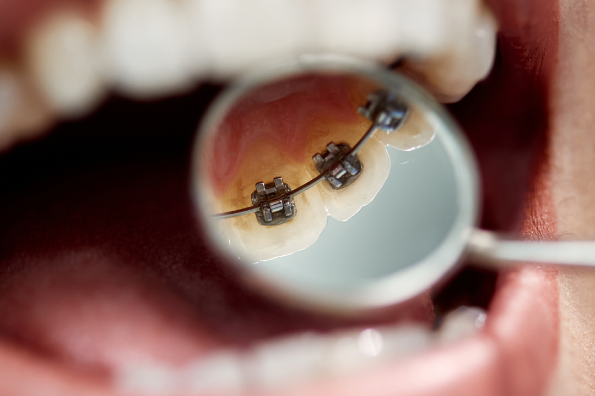 Ortodoncia Lingual: Mitos y verdades de esta innovadora solución para tener una sonrisa perfecta